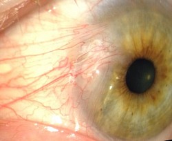 Pterygium