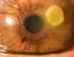 Corneal ulcer