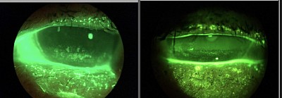 Evidenced based dry eye treatment