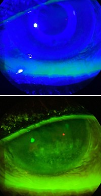 Comparison of standard blue light to the new Fluorescein Exciter filter