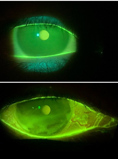 Extended field fluorescein for DED