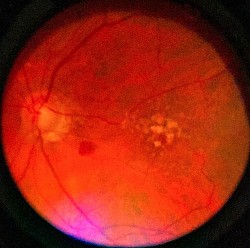 Macular Degeneration