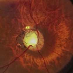 Optic nerve atrophy