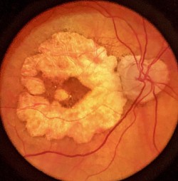 Choroidal atrophy