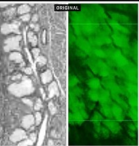 Comparison of histology on left to speed meibography