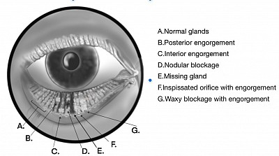 Acinar meibography