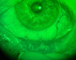 Nodular changes