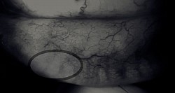 Bloated glands