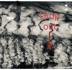 High power shows missing gland