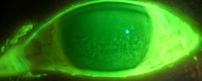 Fluorescein tear film and blink analysis