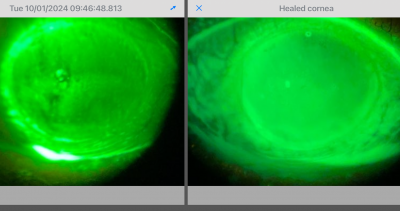 These fluoresceins allow comparison of pre treatment and followup